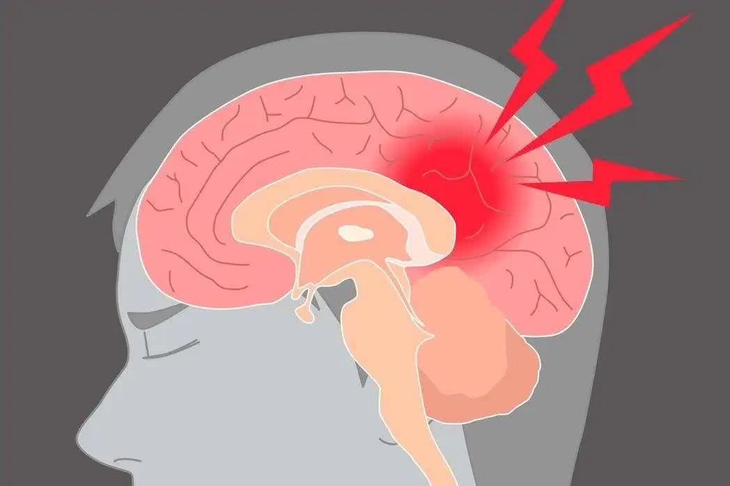 預(yù)防腦梗從習(xí)慣做起,這三大壞習(xí)慣,有的趕緊改正! 預(yù)防腦梗從習(xí)慣做起,這三大壞習(xí)慣,有的趕緊改正!